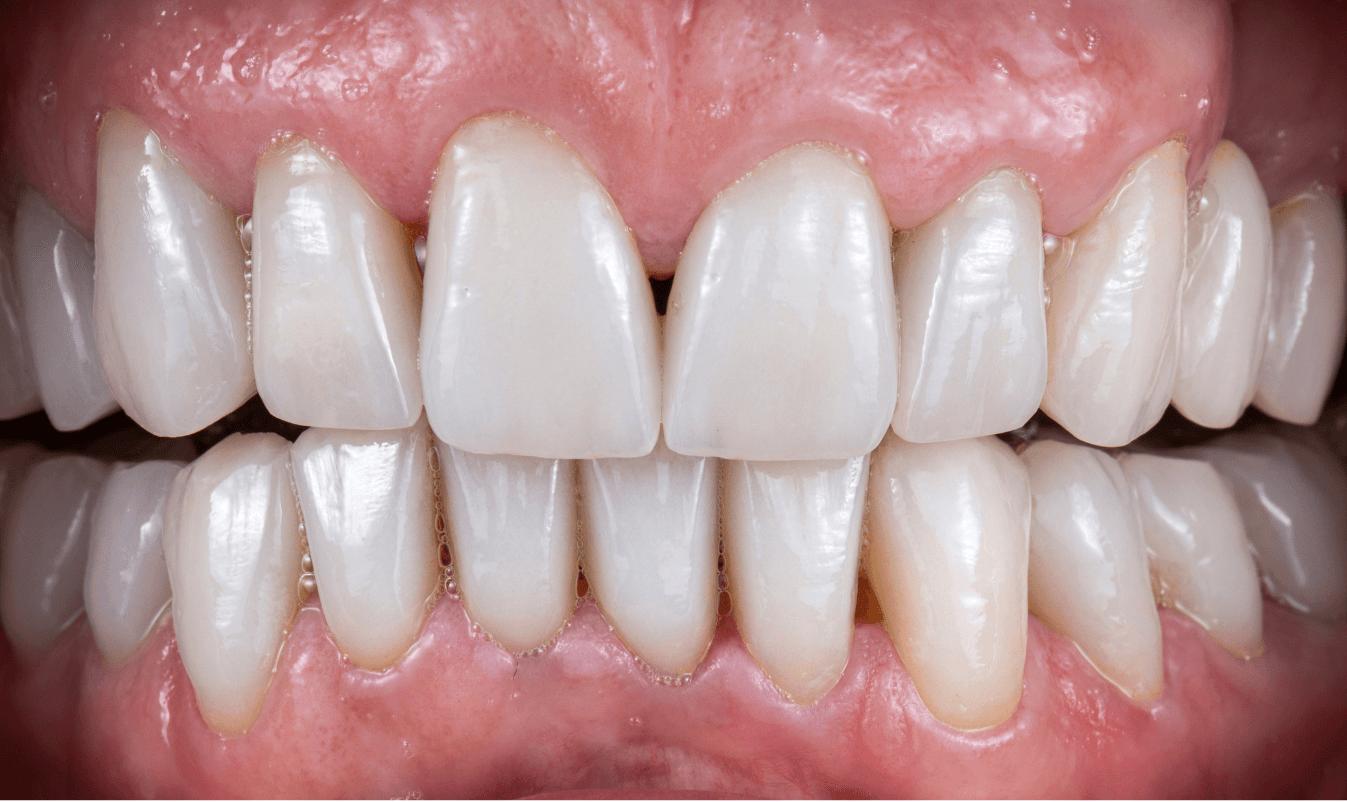 After treatment - Smile Transformation 1