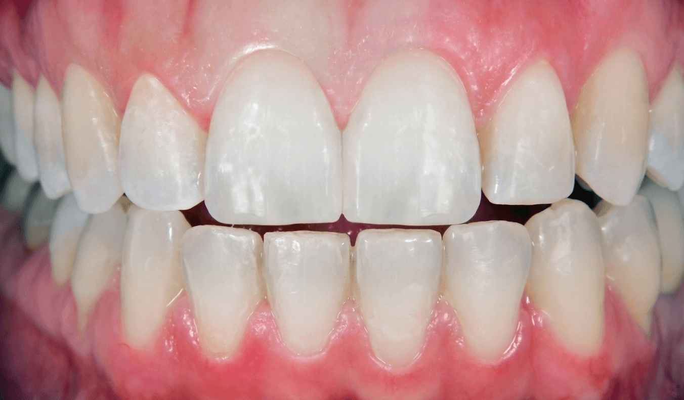 After treatment - Smile Transformation 2