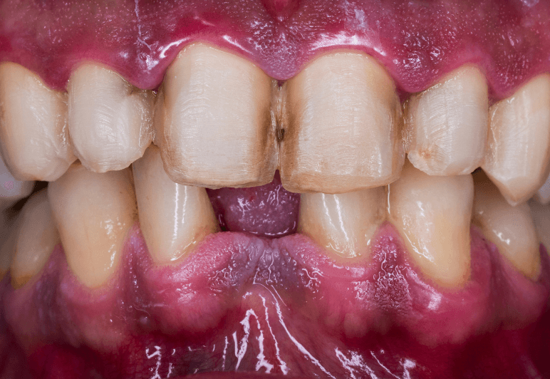 Before treatment - Smile Transformation 1