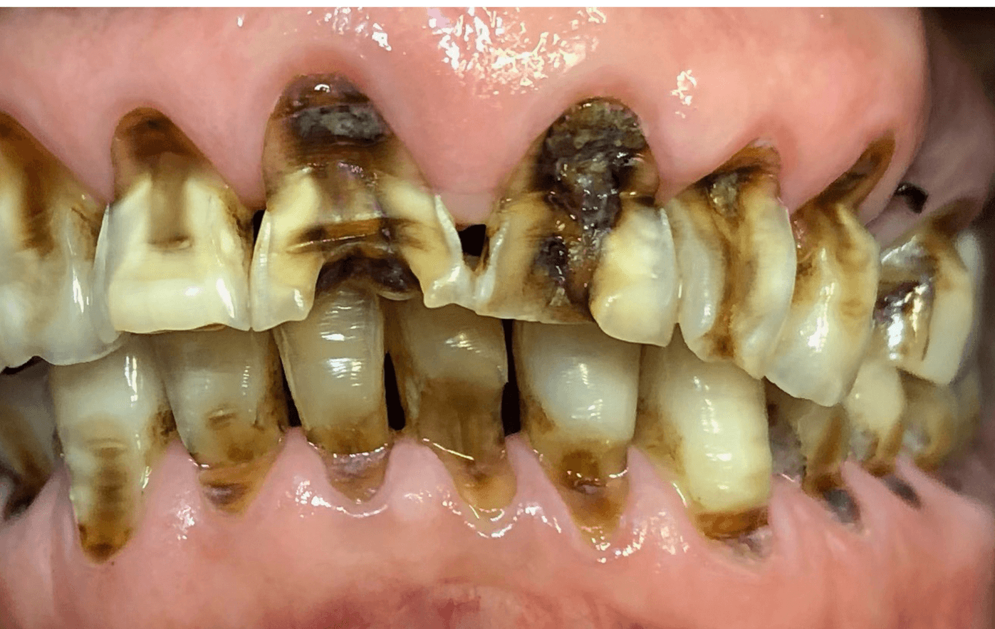 Before treatment - Smile Transformation 2